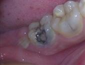 葡萄皮渣可預防牙菌斑和齲齒