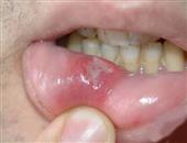 口腔粘膜病包括哪些其主要特点是什么？