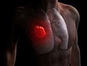 糖尿病人最易发生心梗且没有胸痛征兆