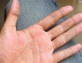 手部湿疹与手癣如何区别治疗