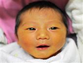 新生儿溶血病症状溶血宝宝易得贫血和黄疸