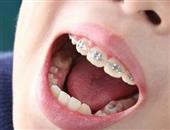 乳牙长得早龋齿发病高