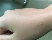 冬季湿疹多因缺水保湿剂要长期使用