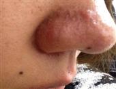 鼻部出现红斑是酒糟鼻症状