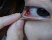 从眼睛看出9种疾病出现麦粒肿警惕皮脂腺癌