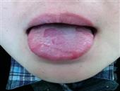 舌破不以为意28岁女子竟患舌癌