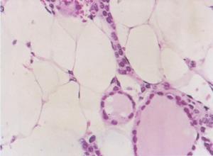 ADH分泌过多综合征