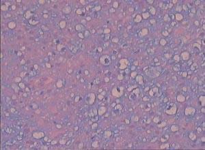 c胰岛功能性β细胞瘤