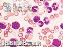 慢性粒细胞性白血病