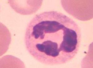 特发性高嗜酸性细胞综合征