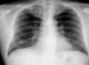 肺错构瘤