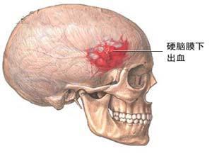 慢性硬脑膜外血肿