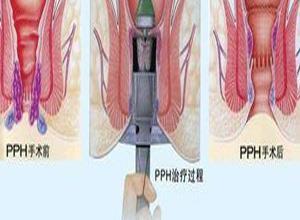 直肠阴道瘘