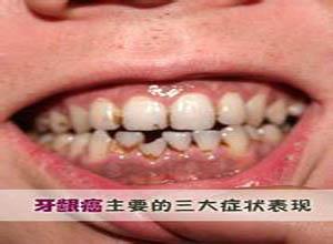牙龈癌