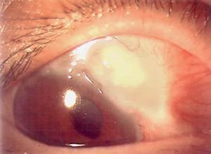 伴有虹膜睫状体炎的继发性青光眼