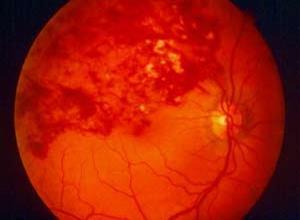 视网膜静脉周围炎