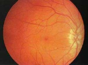 视网膜色素上皮炎