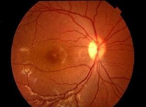 先天性视网膜劈裂