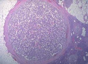 胰岛功能性β细胞瘤