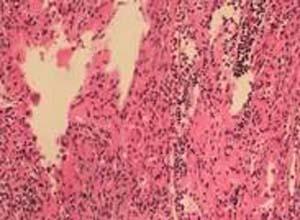 先天自愈性朗格汉斯组织细胞增生症