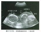 双胎妊娠