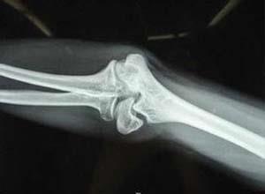 肱骨上端骨骺分离