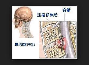 颈椎间盘突出症