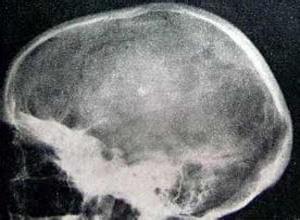 颅骨纤维异常增生症