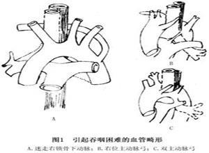 血管畸形引起的吞咽困难