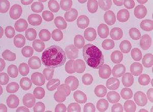 热带性肺嗜酸性粒细胞浸润症