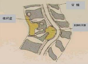 遗传性痉挛性截瘫