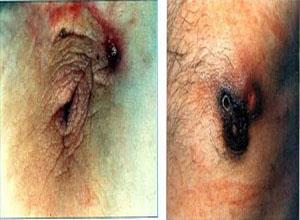 福克斯-阜太斯病