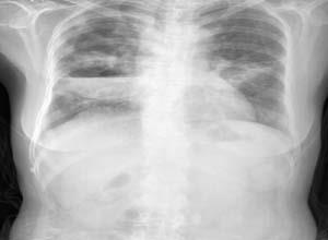 急性肺脓肿