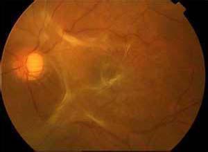 黄斑裂孔性视网膜脱离