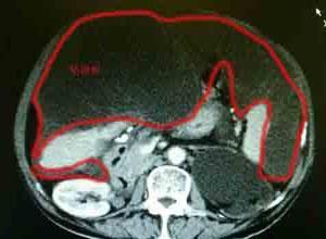 腹膜假黏液瘤