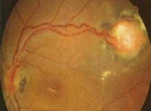 视网膜毛细血管血管瘤