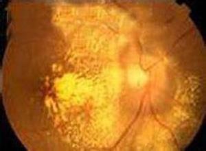 视网膜下纤维化和葡萄膜炎综合征
