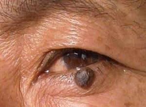 眼睑恶性黑色素细胞肿瘤