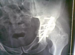 慢性劳损性颈背部筋膜纤维织炎