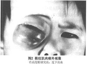 眼眶横纹肌肉瘤