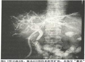 胆道华支睾吸虫病