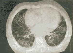 肺泡-毛细血管阻滞综合征