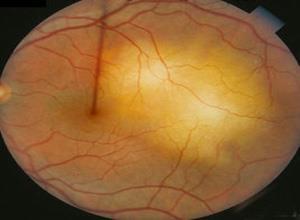 Wegner肉芽肿伴发的葡萄膜炎