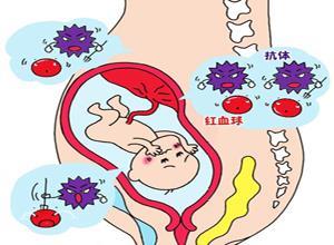 母儿ABO血型不合