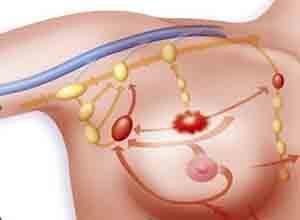 遗传性乳腺癌-卵巢癌综合征
