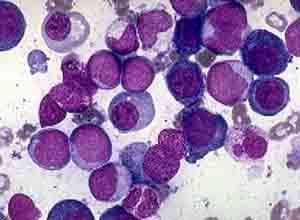 播散性嗜酸粒细胞增多性胶原病
