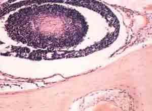 长骨造釉细胞瘤