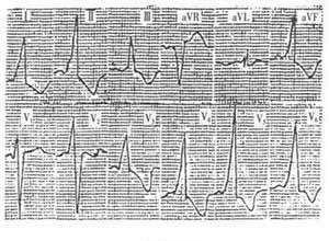 典型预激综合征