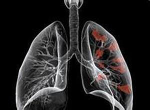 肺部少见的恶性肿瘤