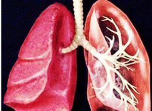 肺泡通气低下综合征